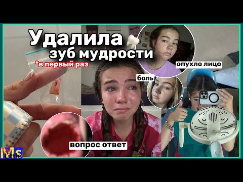 Видео: УДАЛЯЮ ЗУБ МУДРОСТИ || самая сложная неделя в моей жизни || мой опыт+вопрос ответ