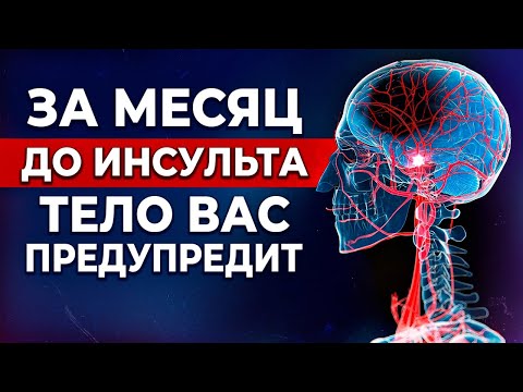 Видео: ОПАСНЫЕ предвестники инсульта! / ПЕРВАЯ ПОМОЩЬ при инсульте
