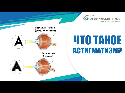 Видео: Что такое Астигматизм - Центр Хирургии Глаза?