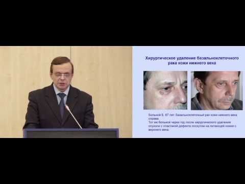 Видео: Операбельный базальноклеточный рак: какой метод лечения выбрать?