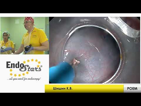 Видео: Ахалазия кардии, клинический случай №8, МКНЦ 23.01.19