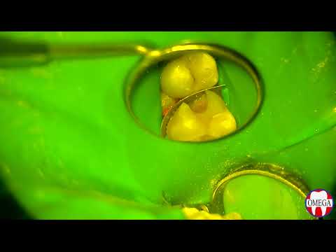 Видео: Лечение кариеса с помощью окклюзионного шаблона