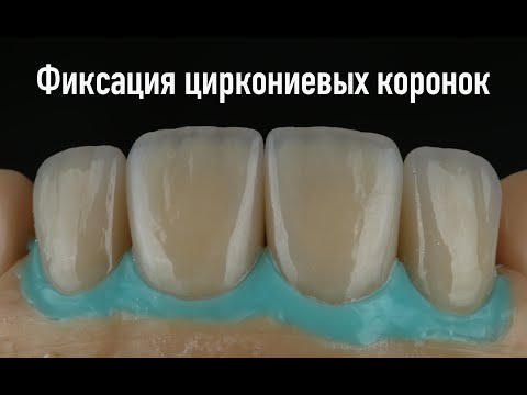 Видео: Протокол фиксации циркониевых коронок