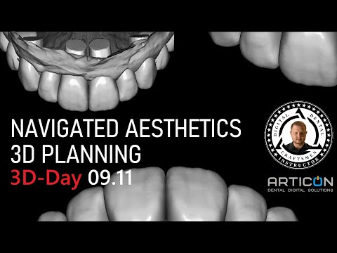 Видео: 3D-Day ARTICON 09.11 - Навигационное эстетическое 3D-планирование