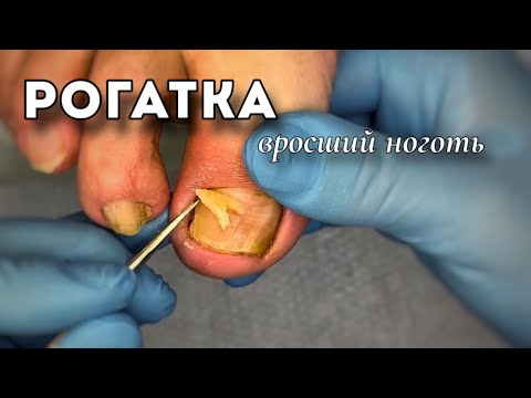 Видео: Вросший ноготь. Как проходит процедура у #подологтатьянапак
