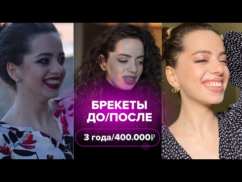 Видео: Посмотри это видео перед тем, как ставить БРЕКЕТЫ. Неправильный/дистальный прикус, каппы, элайнеры