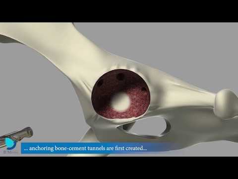 Видео: Эндопротезирование тазобедренного сустава у собаки протезом Biomedrix (краткая методика-анимация)