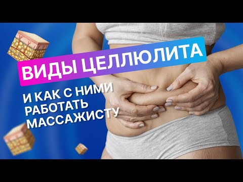 Видео: Какие виды целлюлита бывают? И как с ними работать массажисту.