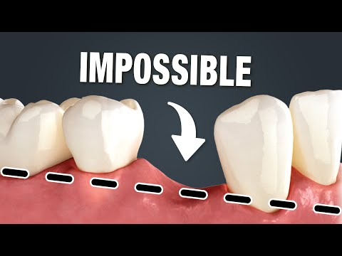 Видео: Имплантаты НЕЛЬЗЯ устанавливать на уровне кости.