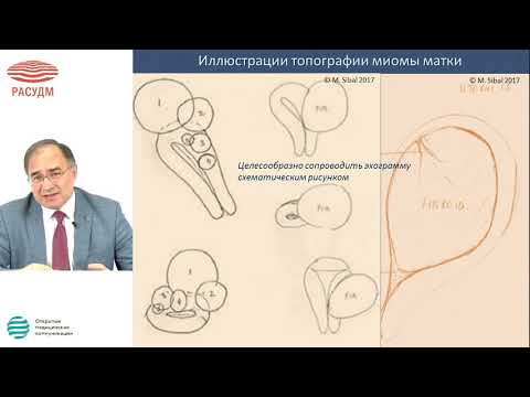 Видео: Ультразвуковая диагностика миомы матки