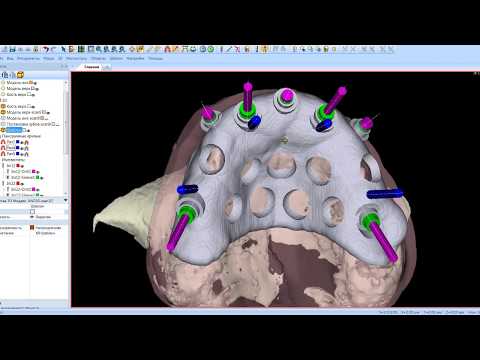 Видео: Планирование хирургического шаблона в программе Implant-Assistant