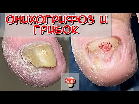 Видео: онихогрифоз / грибок / микоз / толстый ноготь на большом пальце / трихофитон / педикюр