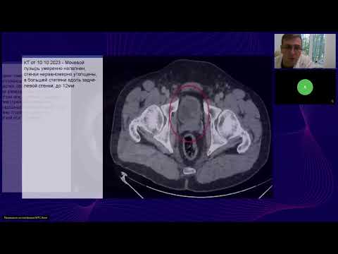 Видео: Место иммунотерапии в лечении рака легкого, мочевого пузыря и ГЦК (вебинар 5 сентября 2024)
