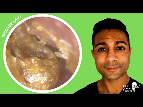 Видео: 1492 — Удаление омертвевшей кожи выявило язву и возможную холестеатому пищевода на ранней стадии