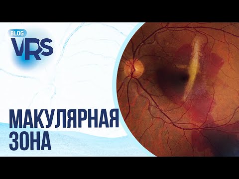 Видео: Травма глаза / Макулярная зона