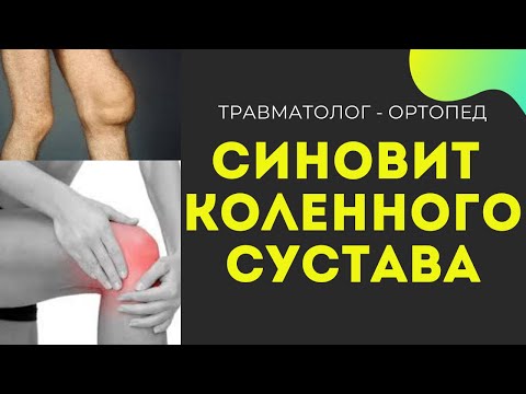 Видео: СИНОВИТ КОЛЕННОГО СУСТАВА | Пункция сустава | Лечение Синовита