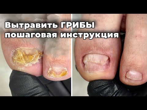 Видео: Все бесполезно, если не соблюсти эту последовательность. Грибок ногтей #pedicure 
