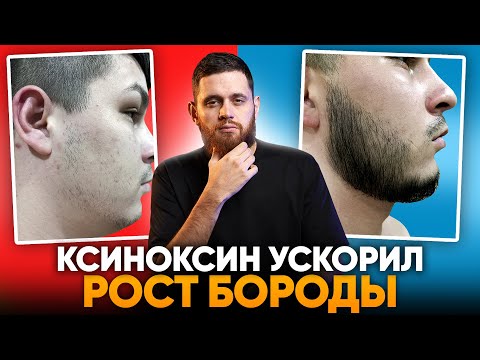 Видео: Первые результаты уже через месяц / Полноценная борода с нуля за 4,5 месяца!