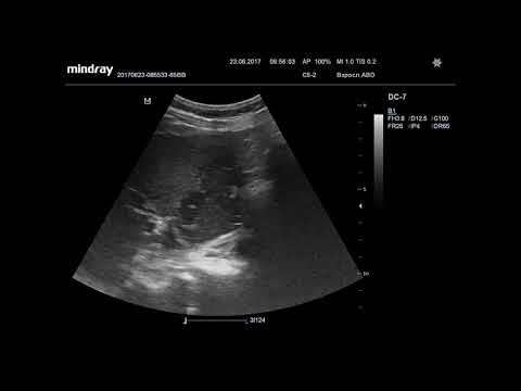 Видео: Ультразвуковая диагностика. Доктор Иогансен. Видеопримеры. Выпуск 7. Опухоль желчного пузыря.
