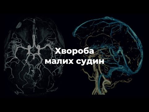 Видео: Хвороба малих судин
