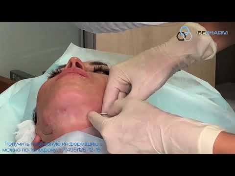 Видео: Видео мастер-класс имплантации нитей на двух иглах