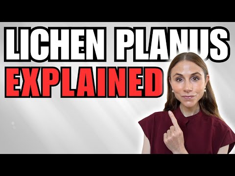 Видео: Красный плоский лишай: симптомы, причины и лечение