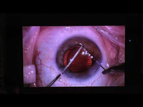 Видео: Цанговая хирургия переднего отрезка глаза