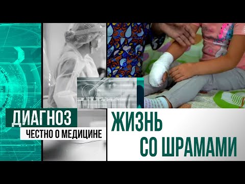 Видео: Как сегодня лечат пациентов с ожогами, и в чём причина детского травматизма? | Диагноз