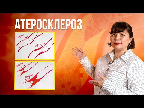 Видео: Атеросклероз. Симптомы, методы профилактики и лечения