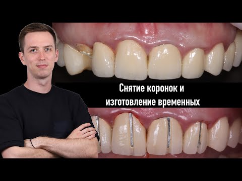 Видео: СНЯТИЕ коронок и изготовление ВРЕМЕННЫХ