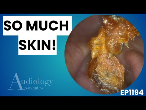 Видео: Экстремальное удаление ушной серы | Столько кожи и серы! - EP1194