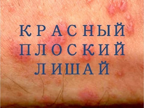 Видео: Красный плоский лишай