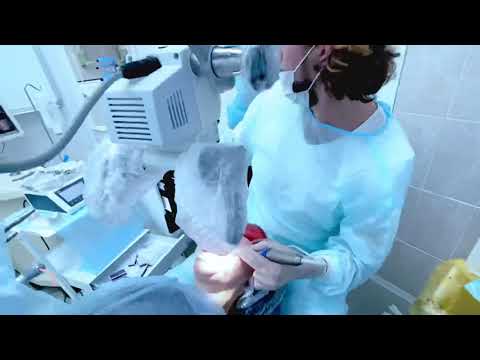 Видео: Имплантация зуба , удаление зуба и установка импланта , лечение и протезирование зубов , без сст ,