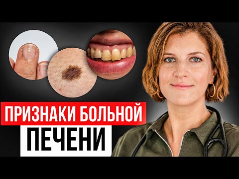 Видео: Скрытые признаки проблем с печенью! НЕ ИГНОРИРУЙ ЭТИ СИГНАЛЫ!