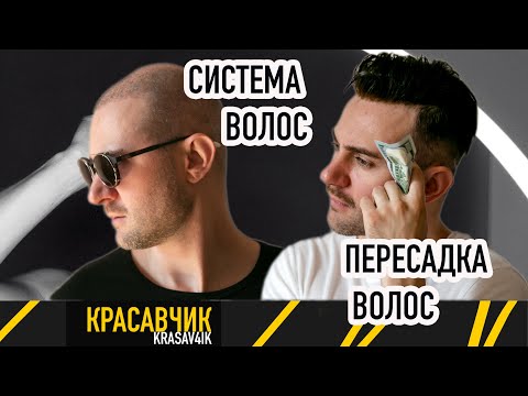 Видео: Что лучше?? Соскучился. Пересадка волос или система волос? \ Красавчик