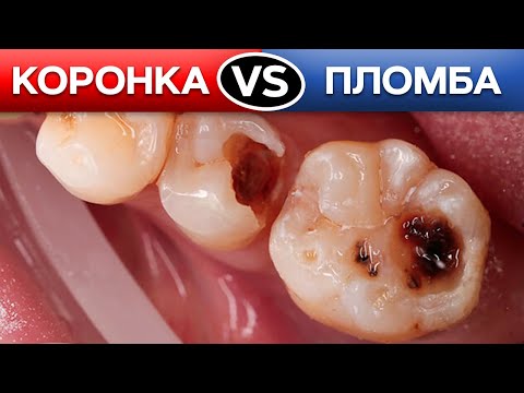 Видео: Вам нужна ПЛОМБА или КОРОНКА? Ответ опытного стоматолога