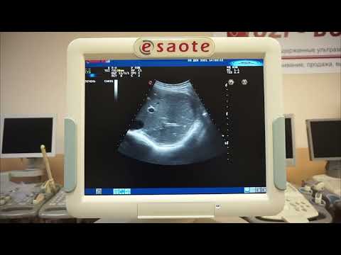 Видео: Esaote MyLab 70 обзор ультразвукового сканера