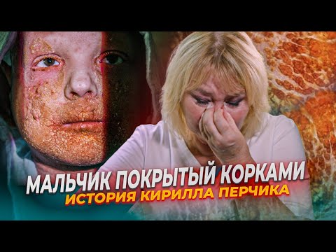Видео: Мальчик, покрытый корками, борется за жизнь
