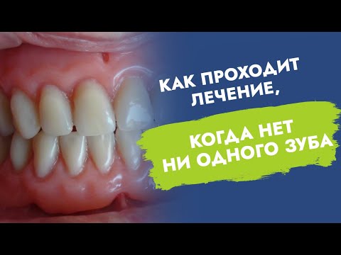 Видео: Не осталось ни одного зуба. Полные съёмные протезы. Как проходит лечение?