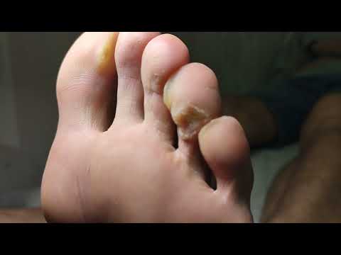 Видео: Бородавка пальца ноги.