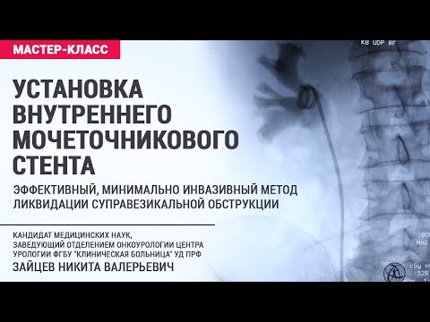 Видео: Установка внутреннего мочеточникового стента