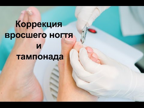 Видео: Коррекция вросшего ногтя и тампонада | Классический Педикюр | Correction of ingrown nail