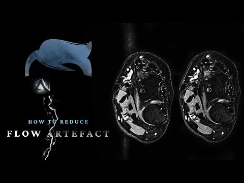 Видео: КАК УМЕНЬШИТЬ АРТЕФАКТЫ ПОТОКА #МРТ
