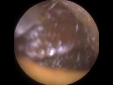 Видео: 841 - Удаление ушной серы у 8-летнего ребенка (Full House)