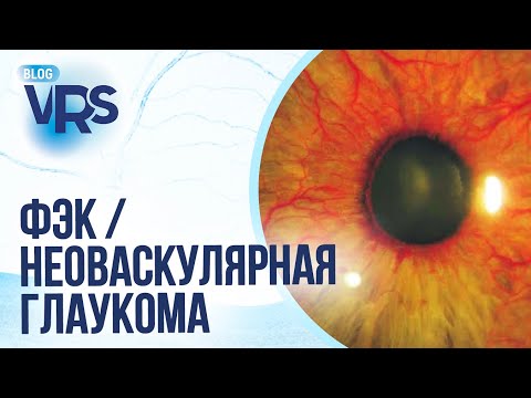 Видео: Сахарный диабет / Диабетическая ретинопатия/ Факоэмульсификация катаракты /Неоваскулярная глаукома