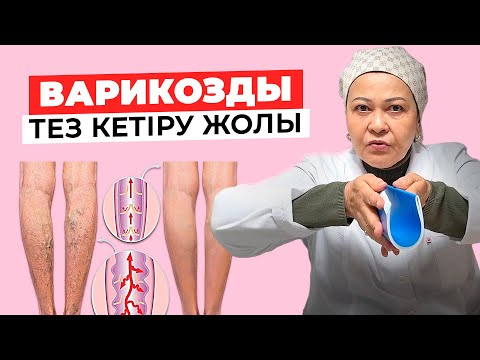 Видео: Аяқтағы варикоздан құтылудың ең оңай емдік жолдары | Варикозды үй жағдайында қалай емдеуге болады