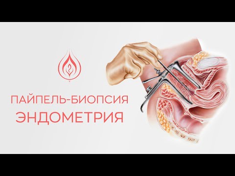 Видео: ​🔎 Пайпель-биопсия эндометрия и как правильно сдать этот анализ?