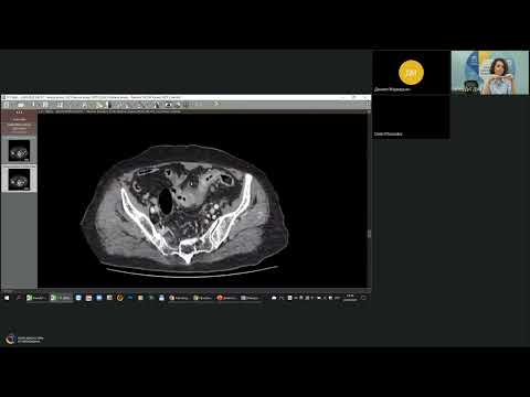 Видео: Онкорадиология в примерах   Партнерский Рак ободочной кишки