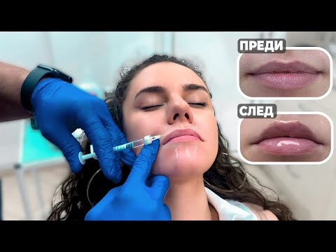 Видео: СЛОЖИХ СИ ХИАЛУРОН В УСТНИТЕ I цени, място, резултат
