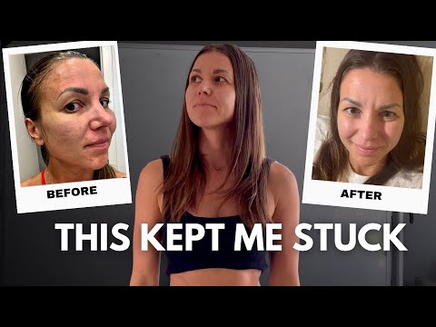 Видео: Как я наконец избавилась от СПКЯ, акне и избавилась от жира на животе (НАСТОЯЩАЯ ПРИЧИНА ВЫСОКОГО...